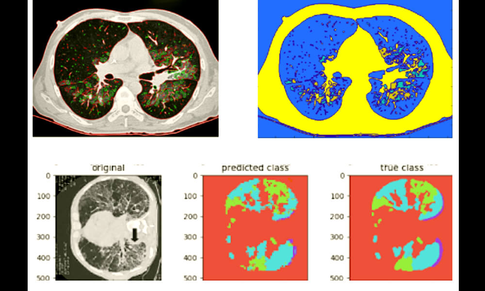 Tomografías del pulmón que toma el sistema auxiliar para diagnóstico de COVID-19